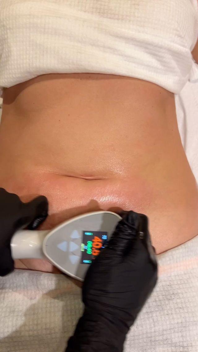 The EXILIS ULTRA 360 (BODY) disrupts and removes fat cells & initiates the process of new fibre formation. This leads to visible improvement in skin tightening and fat reduction. Contact us for more info. 

#btlaesthetics #skintightening #fatreductiontreatment #exilis #serenitypoynton #beautyclinic #poynton #cheshire #cheshire